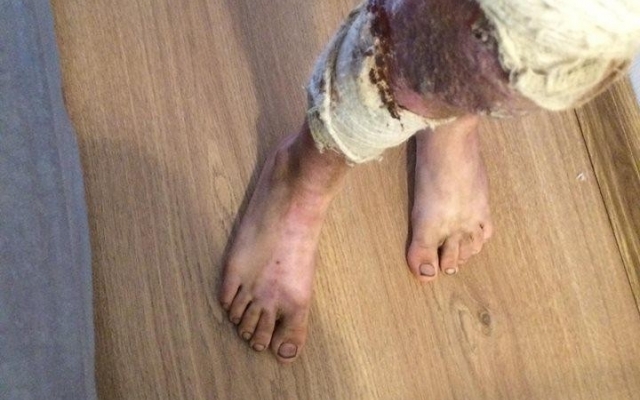 Волонтер из Одессы спасает мальчика в жутких ранениях Фото № 3 Волонтер из Одессы спасает мальчика в жутких ранениях Фото № 3