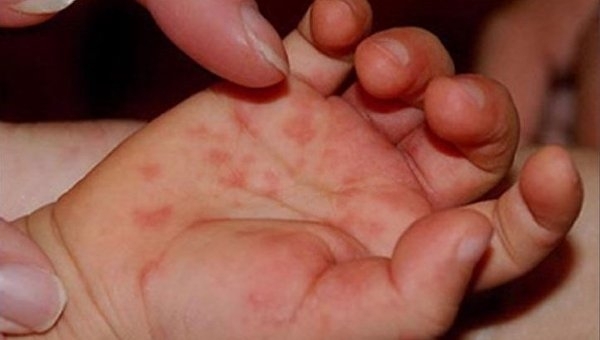 Очередная вспышка кори ожидается в Одессе Фото № 0 Очередная вспышка кори ожидается в Одессе Фото № 0