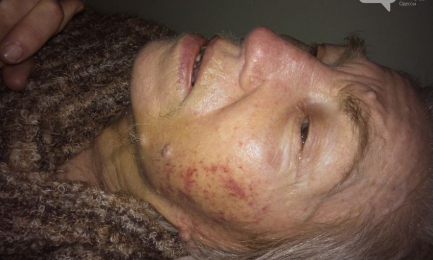 Одесситка обнаружила свою больную бабушку избитой в психдиспансере