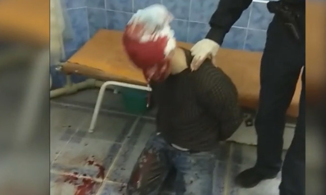 С тяжёлыми травмами мужчина избил врачей «скорой помощи» и сбежал (видео и фото 18+)