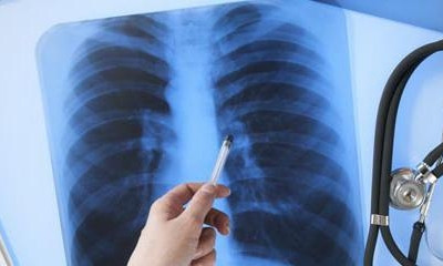 В школах Черноморска зафиксировали случаи туберкулёза
